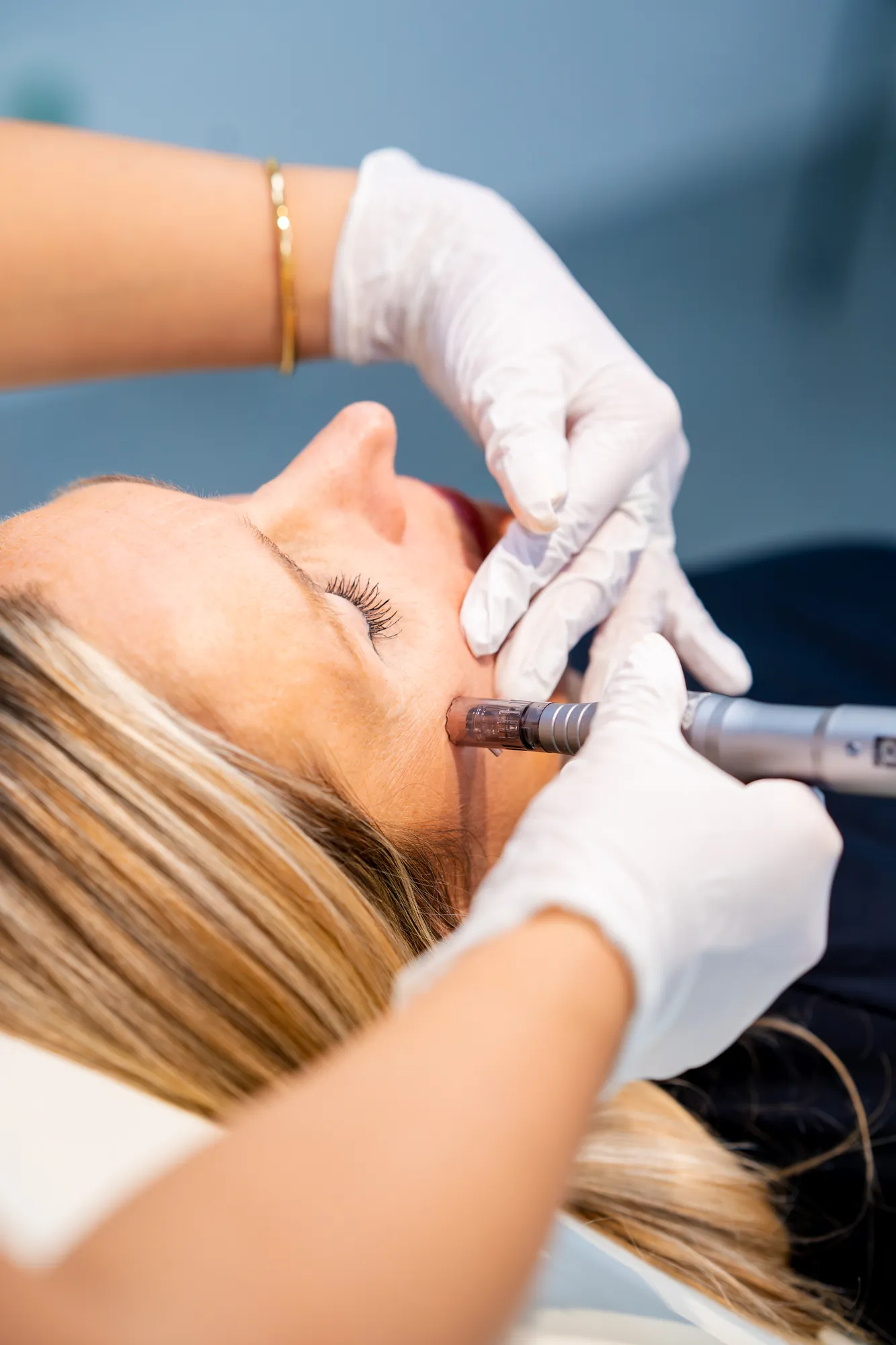 Microneedling-behandeling tegen fijne lijntjes in het gezicht